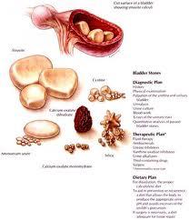 bladder stones