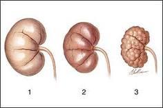 Kidney Failure