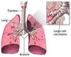 Lung Cancer