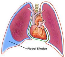 pleural effusion